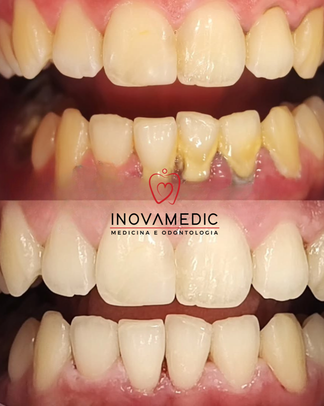 Reabilitação estética — caso A